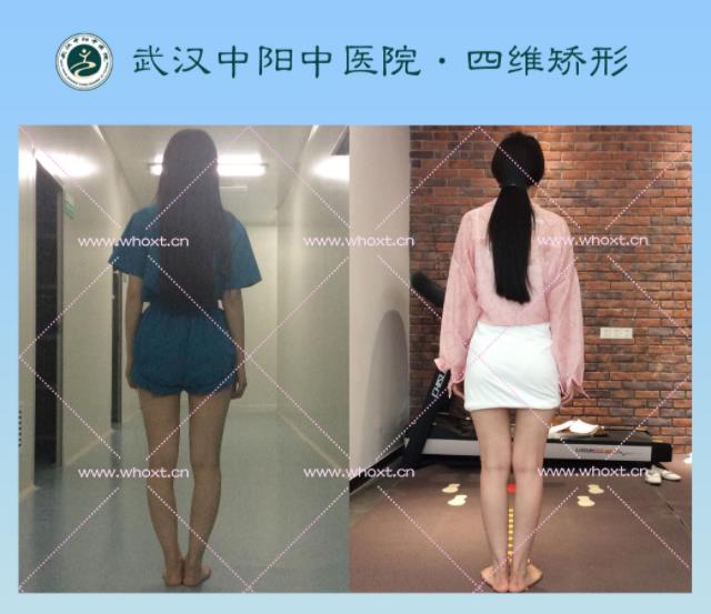 綁腿可以矯正O型腿嗎?武漢中陽醫(yī)院四維矯形技術七天矯正腿型異常