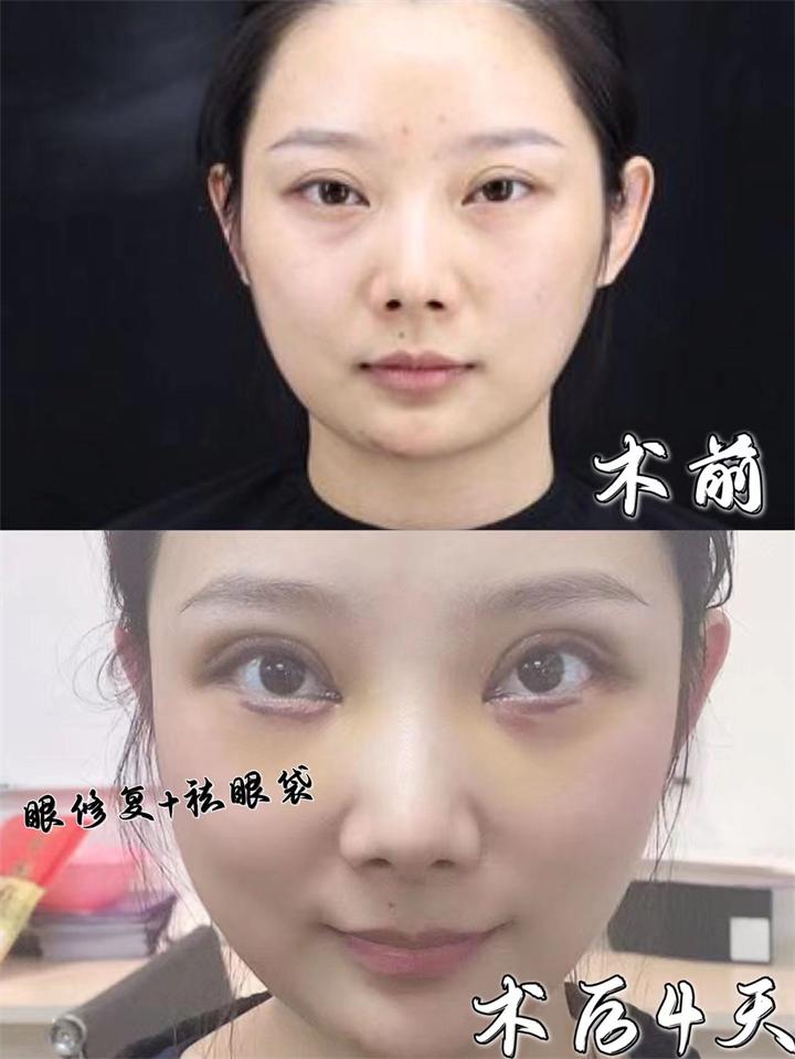雙眼皮修復(fù)_北京哪家醫(yī)院修復(fù)好?