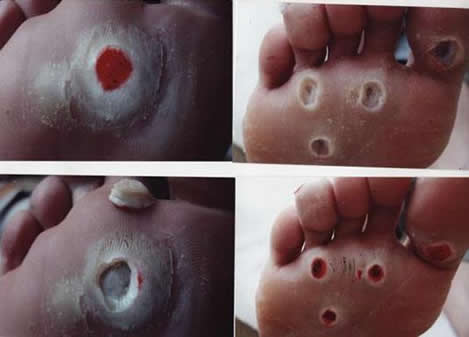 ?雞眼是長什么樣子的圖片 雞眼是怎么形成的如何鑒別