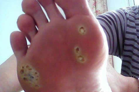?為什么長雞眼會傳染嗎 腳上的雞眼位置圖片怎么根治