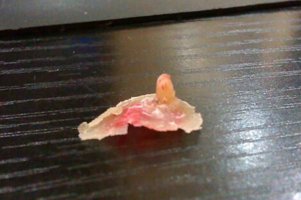 為什么長雞眼會傳染嗎 腳上的雞眼位置圖片怎么根治