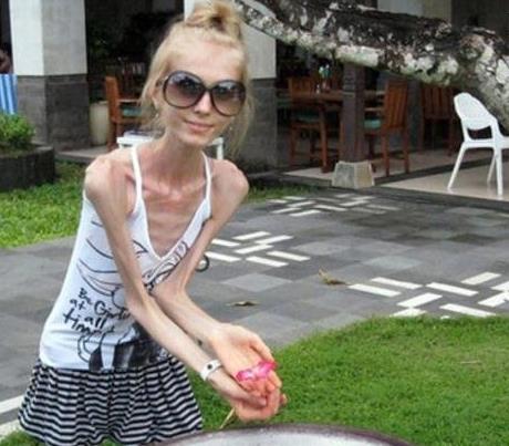 世界上最瘦的女人Kseniya Bubenko,身高158厘米體重20公斤