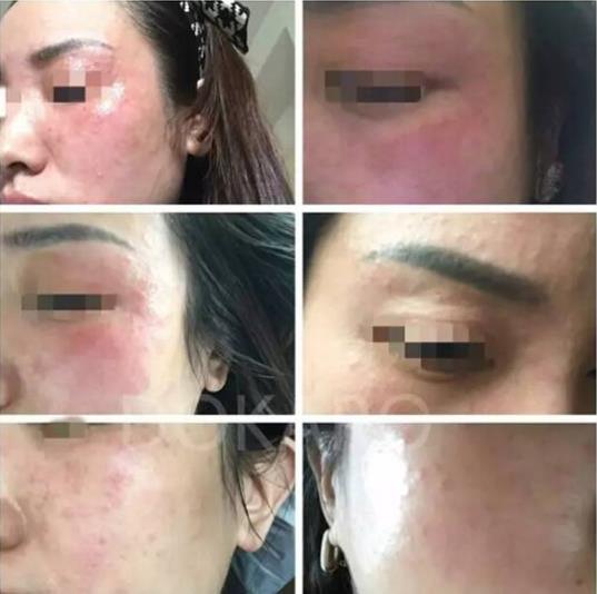 還在煩惱痘痘怎么治?看這里,植晰教你科學祛痘