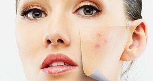 青春痘是生活中很常見的皮膚病 這些去除痘痘紅印的方法記好