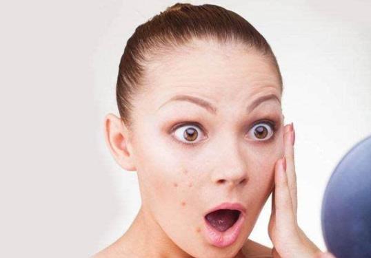 痘痘能不能擠?要不要擠?正確擠痘痘方法及擠痘痘的后續護理