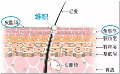 北京伊美爾幸福醫院:閉口粉刺會自己慢慢消失嗎?