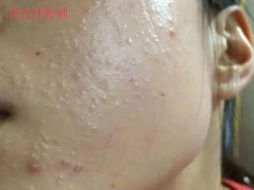 北京伊美爾幸福醫院:閉口粉刺會自己慢慢消失嗎?