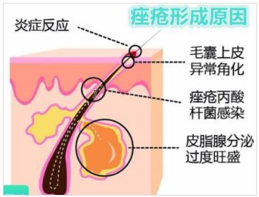北京伊美爾幸福醫院:閉口粉刺會自己慢慢消失嗎?
