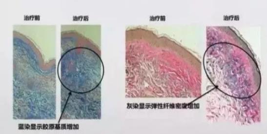 激光祛斑會不會損害皮膚?北京伊美爾健翔醫院