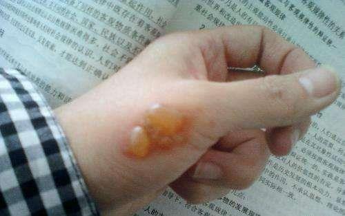 手被燙傷起泡怎么辦?燙傷起泡怎么處理?燙傷的急救處理方法