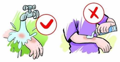 手被燙傷起泡怎么辦?燙傷起泡怎么處理?燙傷的急救處理方法