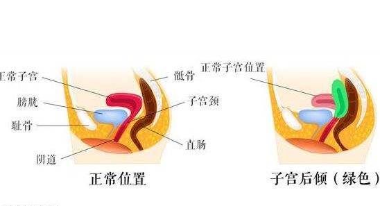 女性子宮后位影響受孕嗎 子宮后位懷孕的4個要點