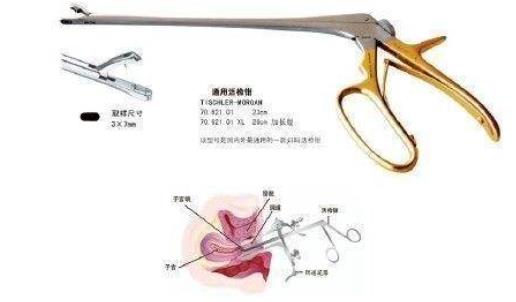 宮頸活檢后注意事項 宮頸活檢多久做一次最好