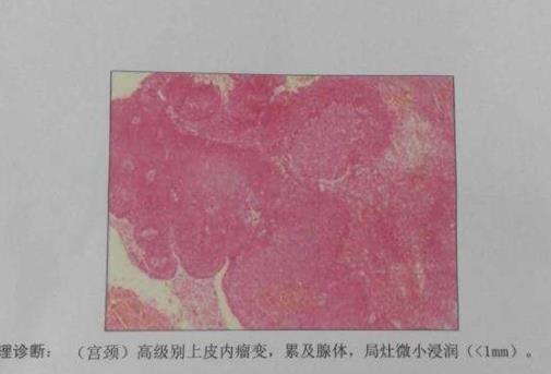 宮頸活檢后注意事項 宮頸活檢多久做一次最好