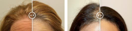 脫發(fā)研究新技術(shù),毛囊干細(xì)胞修復(fù)因子SMAPA可幫助生發(fā)