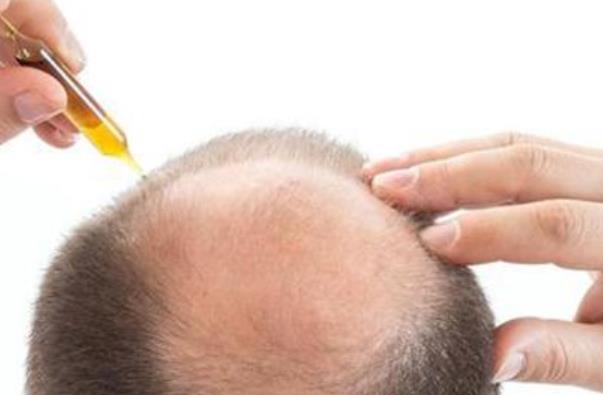 男人脫發(fā)危害大 當(dāng)心影響家庭和諧