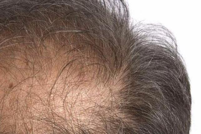 男人脫發(fā)危害大 當(dāng)心影響家庭和諧