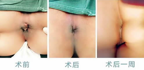 女性痔瘡真人實(shí)拍圖片 網(wǎng)上曝光的7個小偏方有效治痔瘡 女性痔瘡真人實(shí)拍圖片:網(wǎng)上曝光的7個小偏方有效治痔瘡