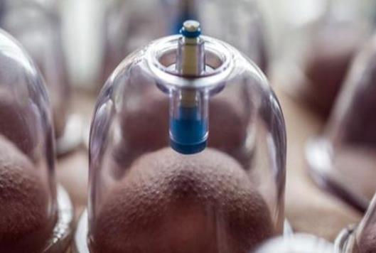 拔罐腰部黑紫跟婦科病有關嗎 拔罐腰部黑紫說明什么