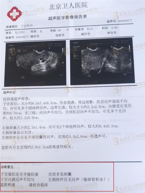 子宮腺肌癥能保住子宮嗎?50歲包大姐終于打贏這場(chǎng)長(zhǎng)達(dá)20年的“子宮保衛(wèi)戰(zhàn)”!