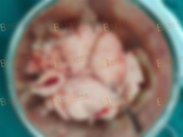 子宮腺肌癥能保住子宮嗎?50歲包大姐終于打贏這場(chǎng)長(zhǎng)達(dá)20年的“子宮保衛(wèi)戰(zhàn)”!