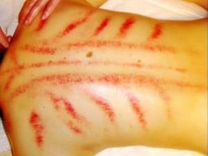 哪些人不適合刮痧?刮痧有什么禁忌