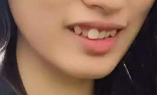 怎樣判斷是不是齙牙 齙牙會遺傳嗎