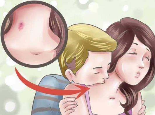 種草莓 吻痕.jpg