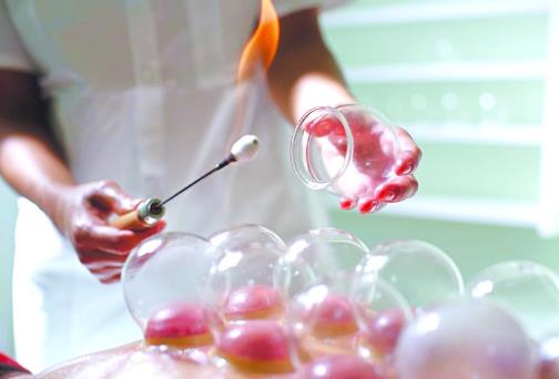 拔火罐能減肥嗎?拔火罐減肥有用嗎