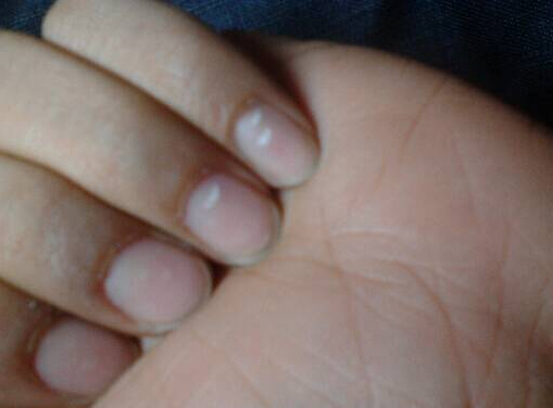 寶寶手指上有白點(diǎn)怎么辦?手指上的白點(diǎn)看健康狀況