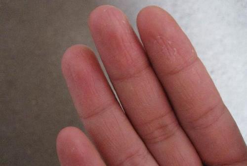 手癬——傳染性很強的病