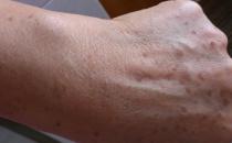 充足睡眠預防老年斑 吃什么可以祛除老年斑？