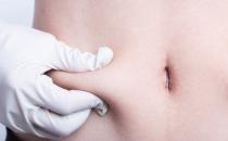 360環形抽脂 造就完美身材