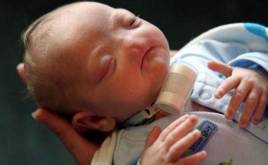 沒有鼻子的嬰兒,媽媽說他是完美的