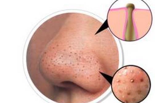 患有草莓鼻怎么辦 幾招幫你恢復(fù)細致毛孔