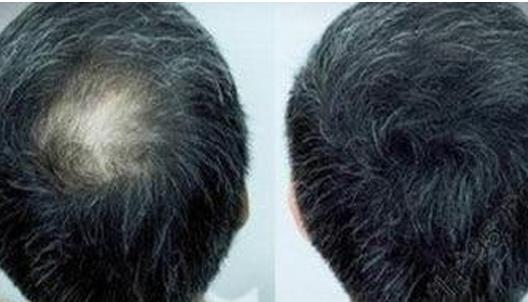 頭發種植的方式有哪些？