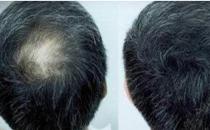 頭發種植的方式有哪些？