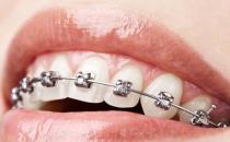 牙齒整形的幾個誤區要當心