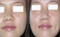 人造酒窩的切口有多大？