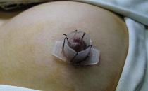 乳頭內陷矯正后乳頭有敏感度