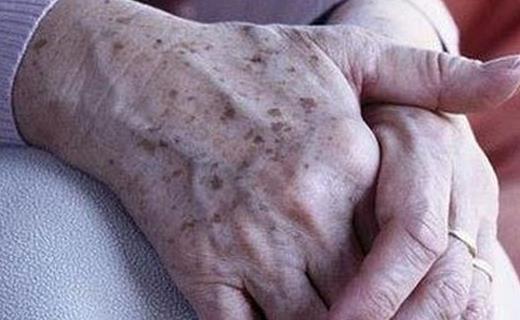 老年斑的消除方法?三招教你去除老年斑