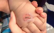 孩子常見的意外損傷類型有哪些？