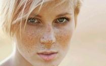 雀斑和吃鹽有關系？雀斑會遺傳嗎？