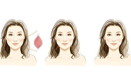 打瘦臉針有什么副作用?