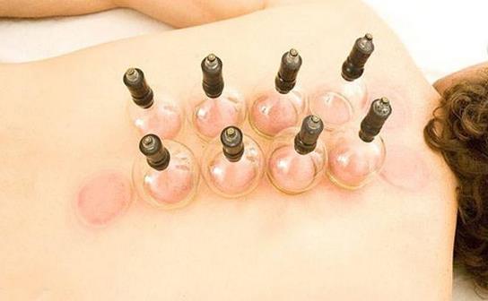拔罐減肥的原理是什么 找準穴位就能一瘦到底
