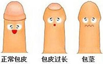 【包皮包莖】包皮包莖有哪些癥狀_包皮包莖如何治療_包皮包莖的原因 【包皮包莖】包皮包莖有哪些癥狀_包皮包莖如何治療_包皮包莖的原因