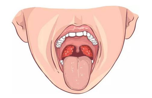 扁桃體發炎吃什么湯 食療效果好