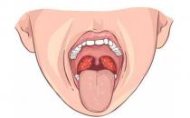 扁桃體發炎吃什么湯 食療效果好