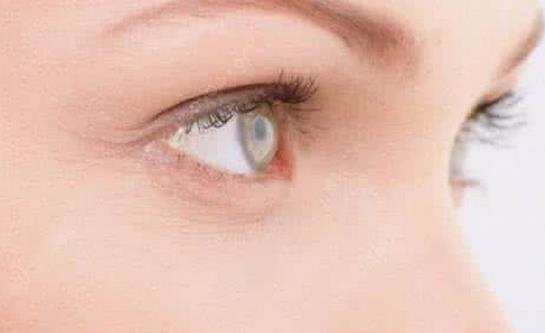 得了紅眼病不能吃什么