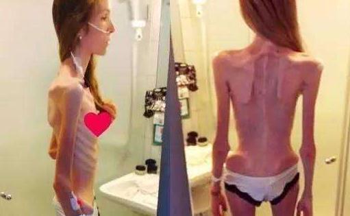 女孩1米8重30公斤 厭食癥的危害